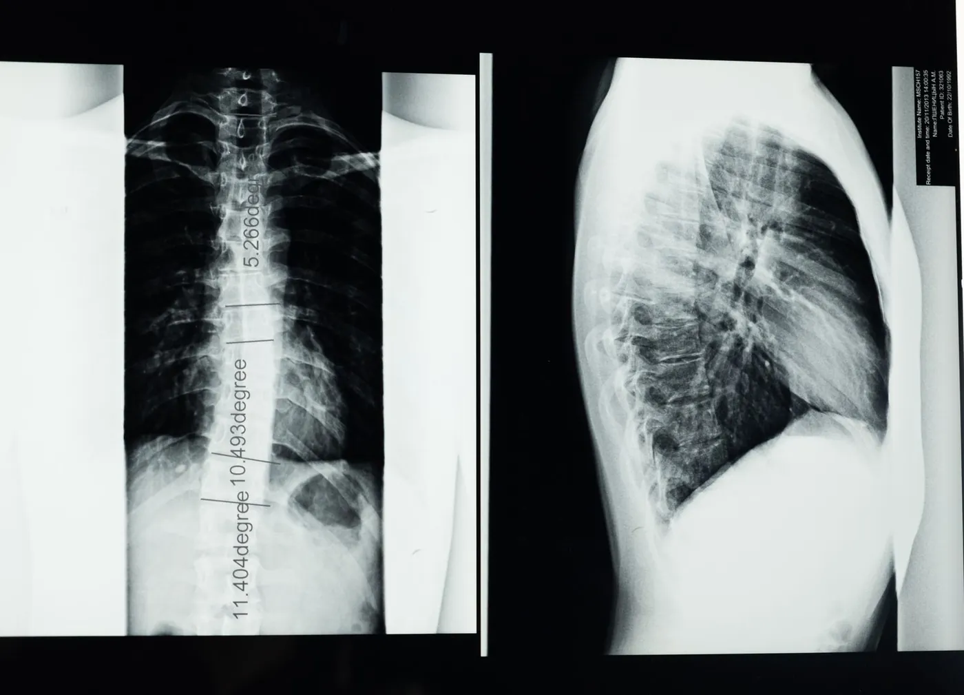 Bone and calcium disorders treatment in Lahore: spine X-ray films