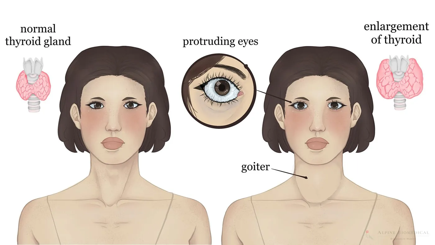 Illustration of Graves' disease: protruding eyes and an enlarged thyroid beside a normal neck