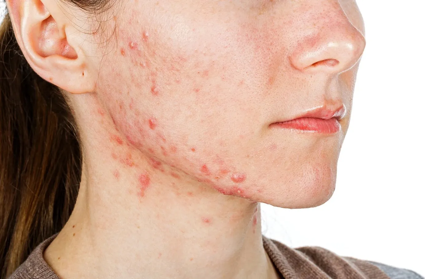 Acne along a woman's cheek and jaw