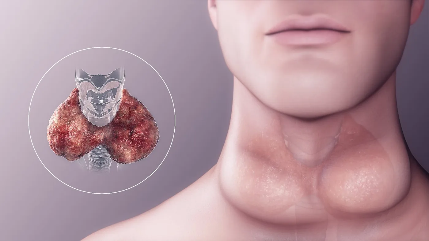 Illustration of the thyroid gland at the front of the neck