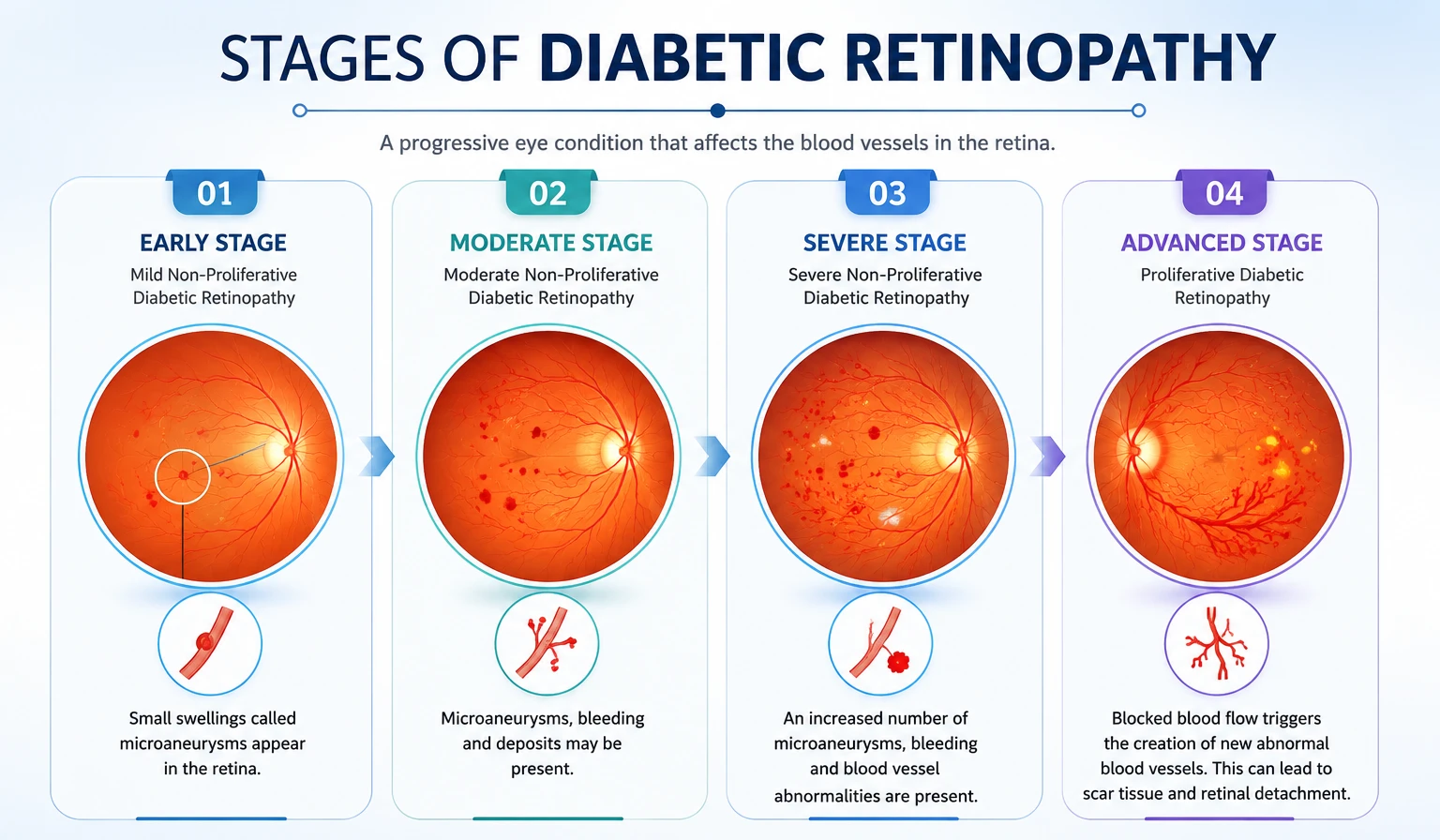 Stages of diabetic retinopathy from early to advanced - screening in DHA Lahore