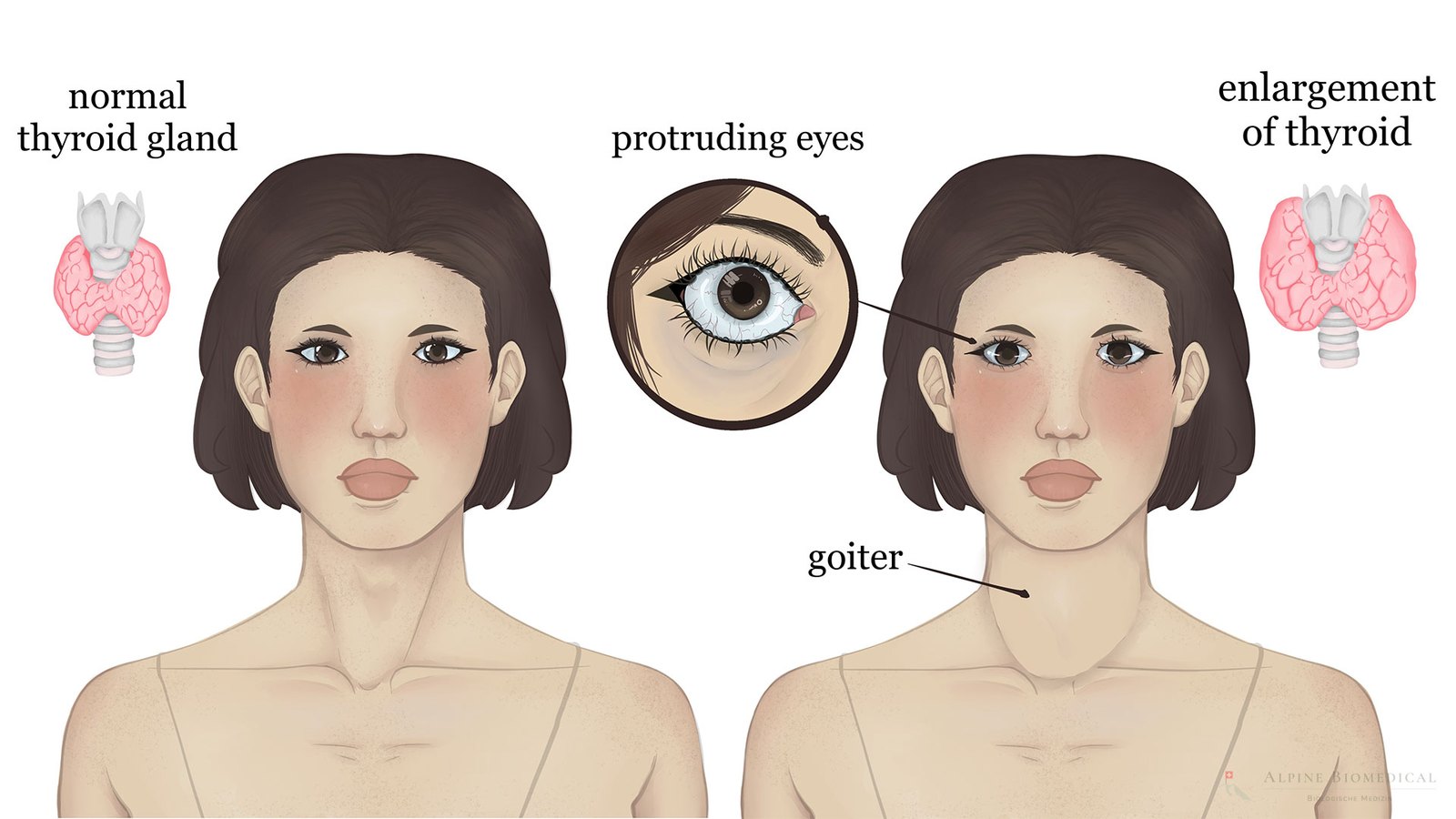 Graves thyroid disease symptoms explained, DHA Lahore