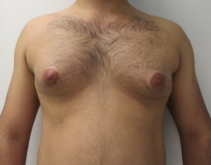 Male chest with gynecomastia, DHA Lahore