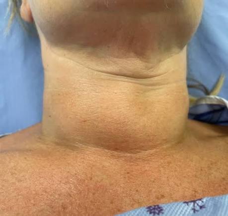 Multinodular goiter neck swelling, DHA Lahore