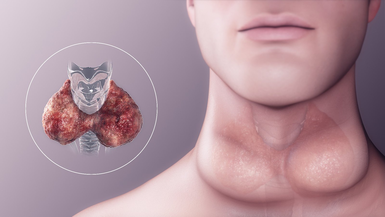 Thyroid gland anatomy illustration, hyperthyroidism, DHA Lahore